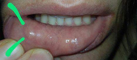 Knubbel an der Unterlippe - Krebs?