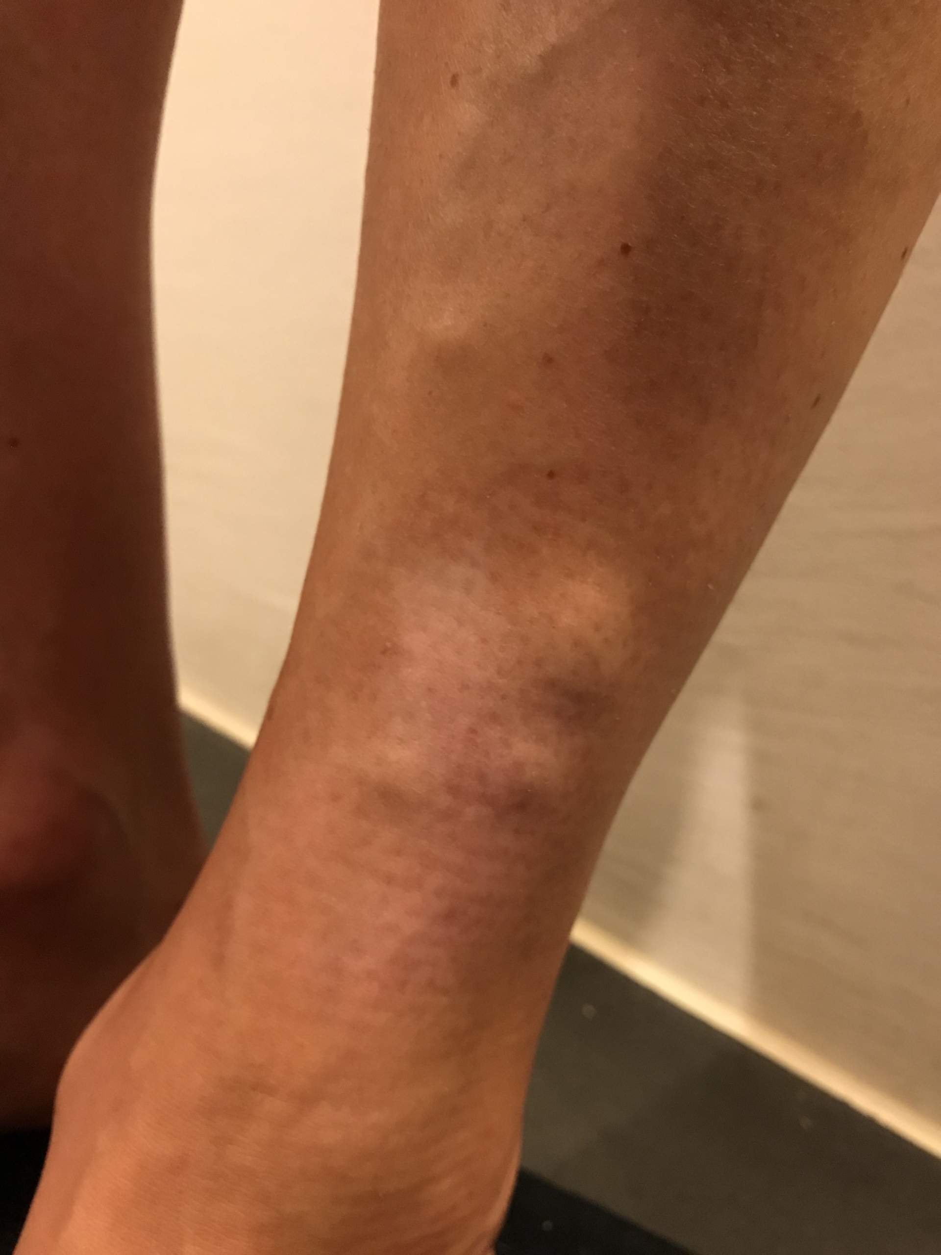 Knubbel an Unterschenkel? (Orthopäde)