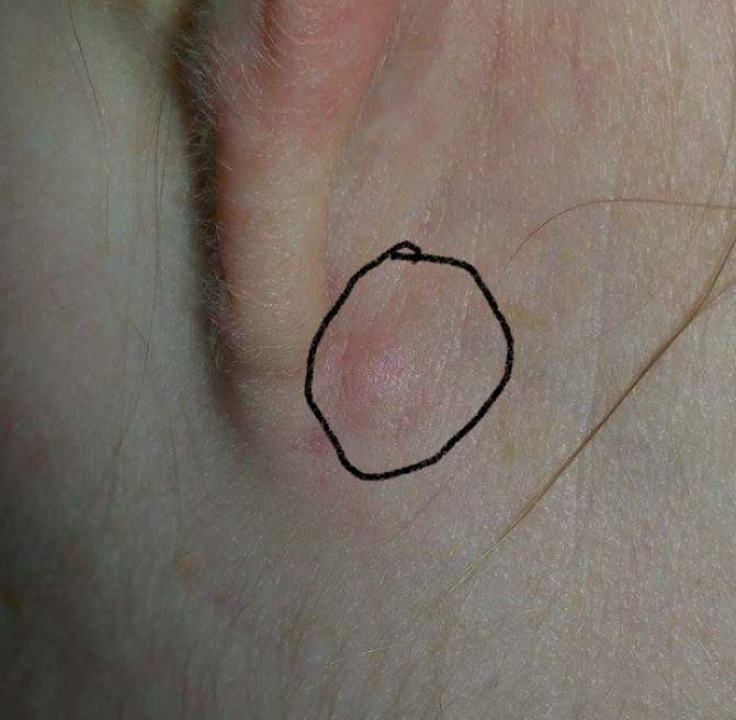 Hinterm ohr verhĂ€rtung Parotitis (OhrspeicheldrĂŒsenentzĂŒndung):