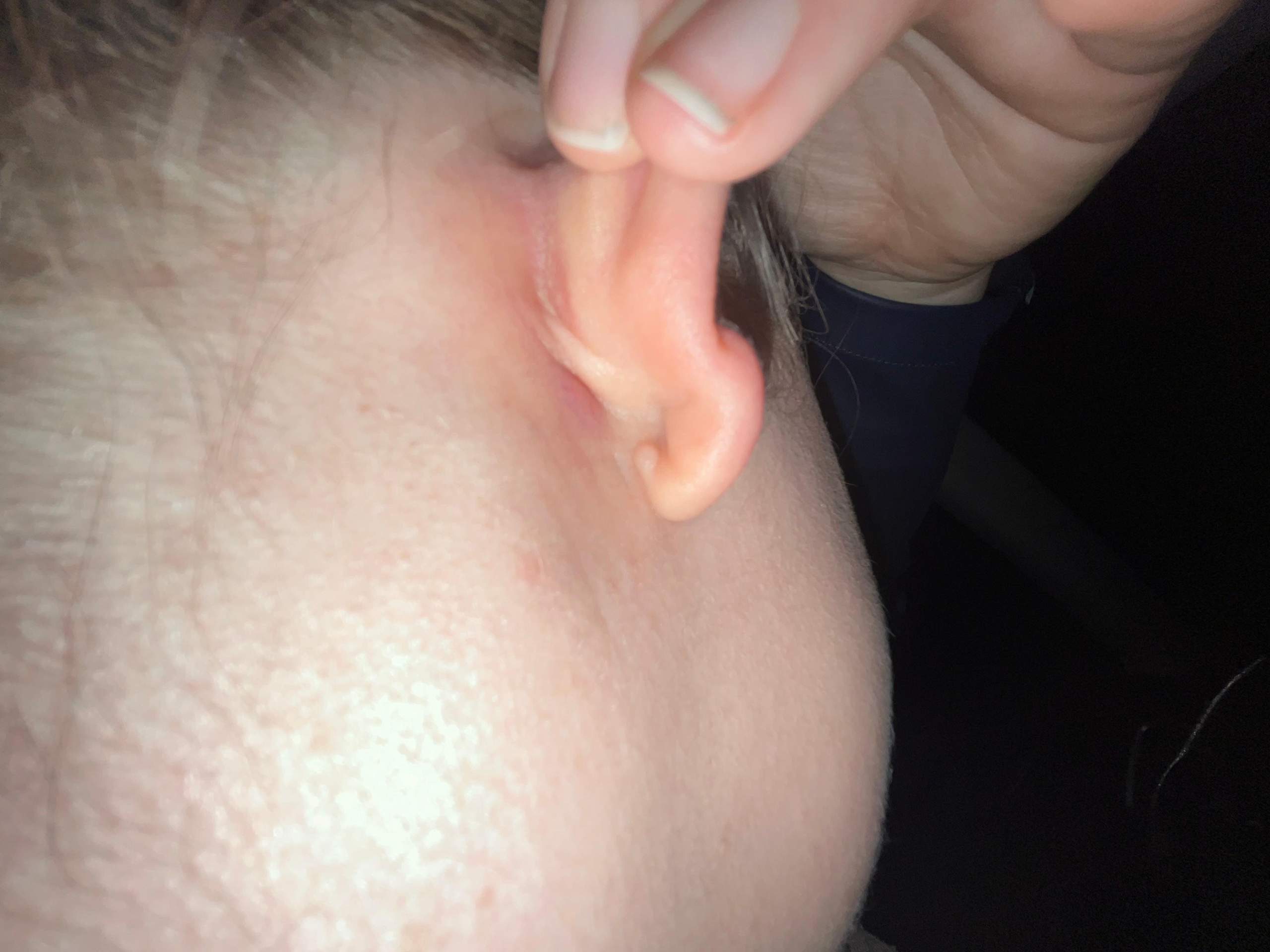 Knubbel hinter Ohr? (Lymphknoten, Lymphknotenschwellung)