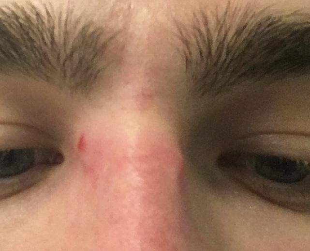 Knubbel unter der Haut, dort wo die Brille auf der Nase aufliegt