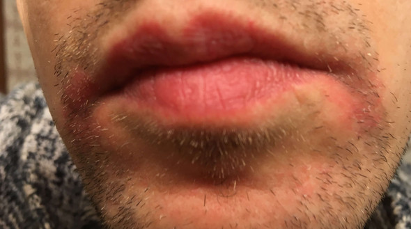 Rote Stellen um neben den Mund - (Gesicht, rote Flecken, mundrose)