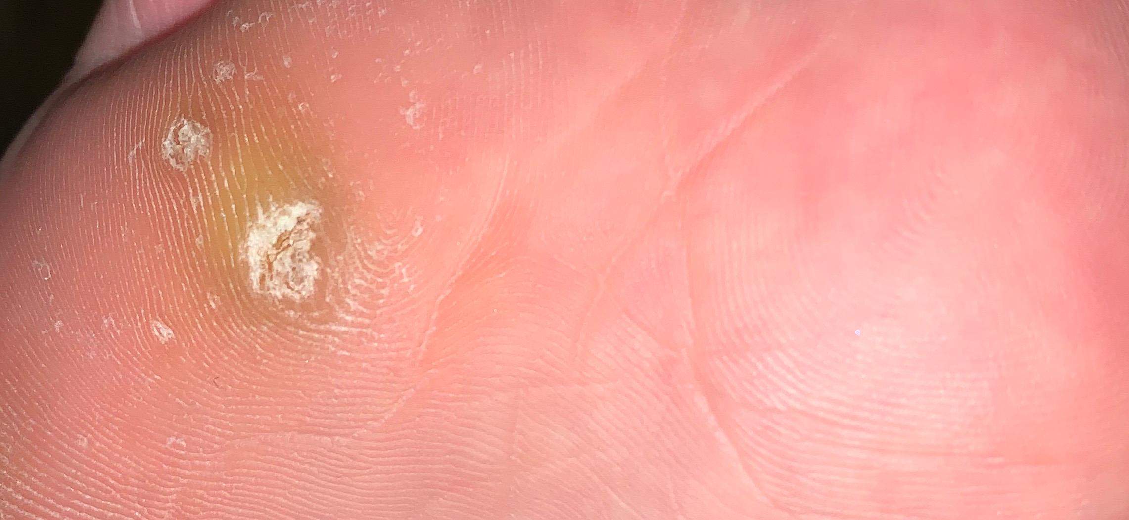 Könnte das Eiter sein? (Haut, Fußschmerzen, Hühnerauge)