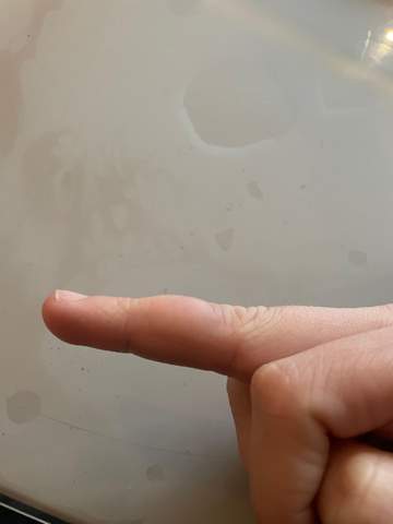 Komische Blase an Finger , was kann das sein?