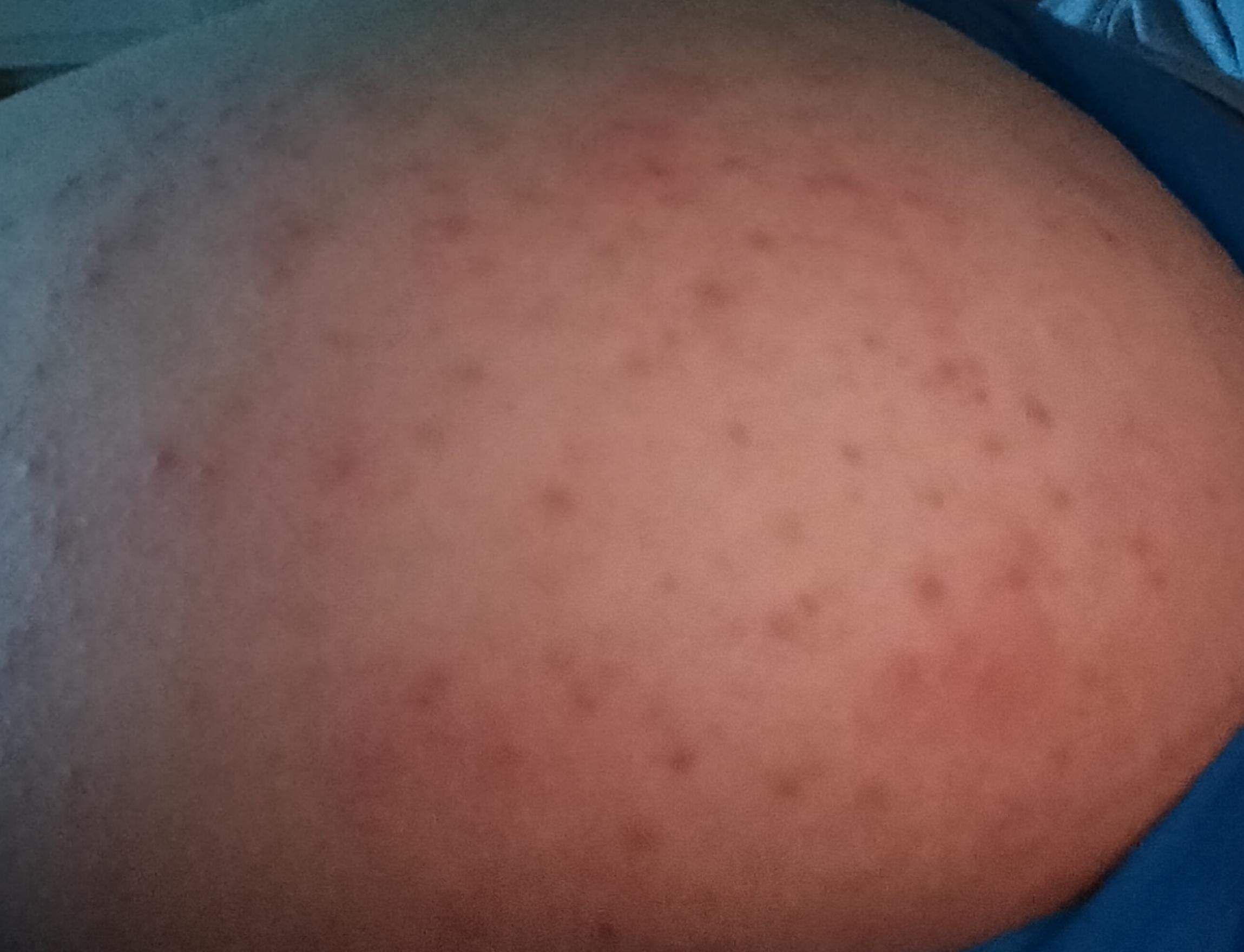 Komische Extrem Viele Pickel am Po? (Haut, Juckreiz, Wärme)