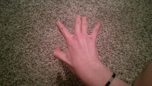 drittes Fingerglied komisch abknicken (sicht von oben) - (Krankheit, Hand, Finger)