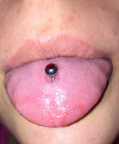 Komische Flecken auf der Zunge, was ist das?