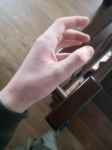 Komische pickel an der hand?