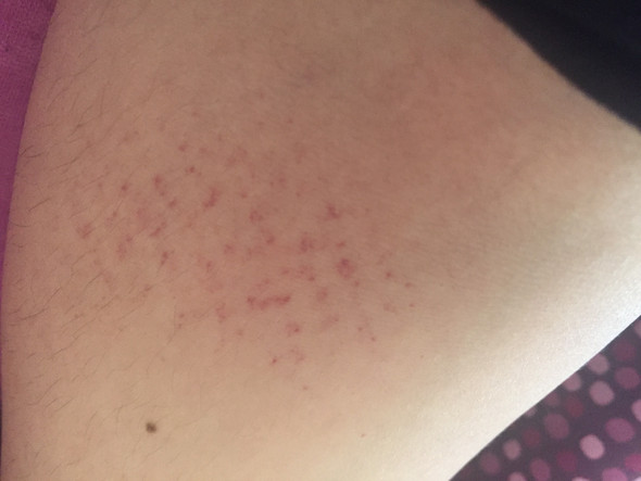 Komische Punkte Auf Dem Arm Hilfe Rote Punkte Komische Punkte Auf Dem Arm Hilfe Rote Punkte