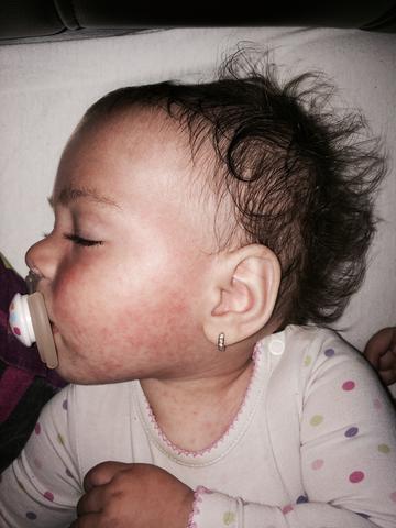 Komischer ausschlag (Mittelohrentzündung)