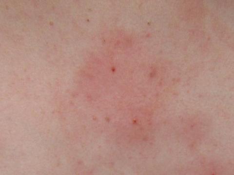 Komischer Ausschlag An Der Brust Was Konnte Das Sein Haut Juckreiz Komischer Ausschlag An Der Brust Was Konnte Das Sein Haut Juckreiz