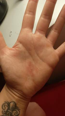 - (Juckender Ausschlag, Handausschlag)