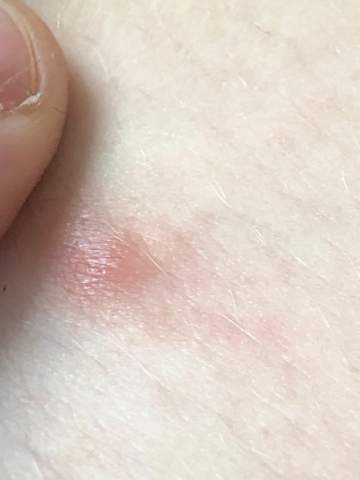 Komischer aussehender Pickel am innen Oberschenkel? pickel an oberschenkel