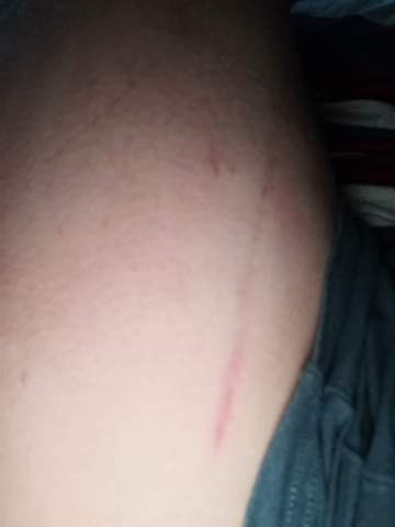 Komischer Roter Streifen Am Oberschenkel Haut Ausschlag Dermatologie