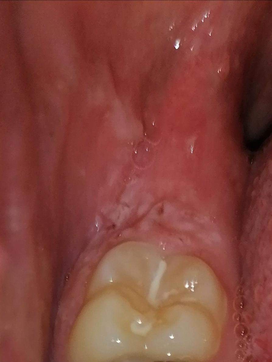 Komisches weißes Zeug am Backenzahn? (Zahnfleisch, Was tun)