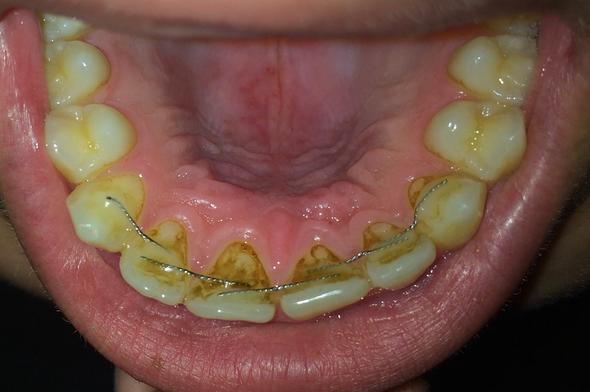 Oberkiefer - (Zähne, Zahnarzt, Mund)
