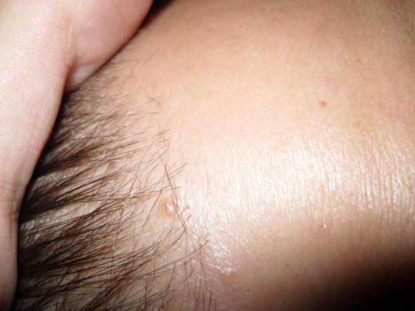 Vorne Scheitel, nasse Haare - (Kopfhaut, Cortison)