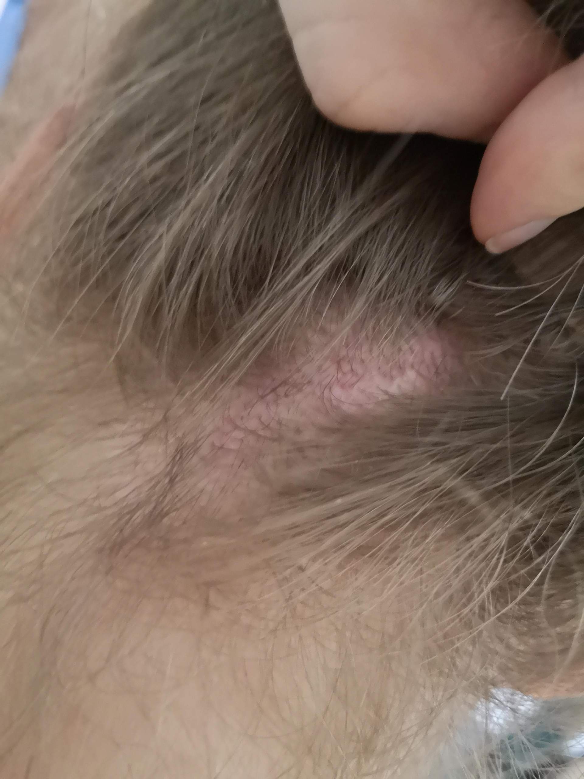 Kopfhaut juckt plötzlich und ist rot?