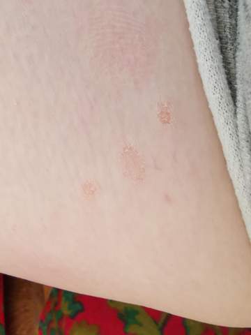 Kreisförmiger Ausschlag, was ist das?