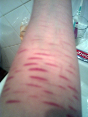 Wallpaper zu weihnachten (12 handy hintergrundbilder) kostenlos downloaden Kriege ich diese Narben irgendwie weg? (Haut)