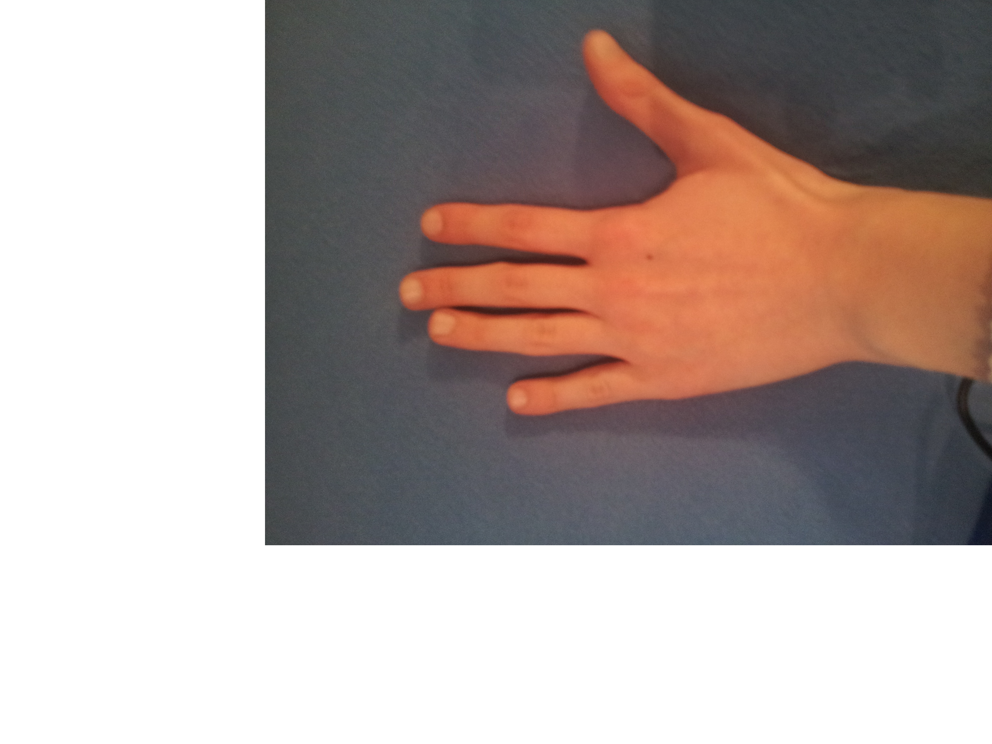 Krumme Finger - Ursache? Was tun? (Orthopädie)