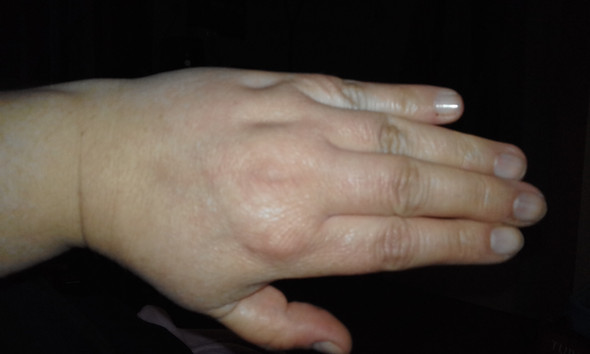 - (Finger, Krümmung)