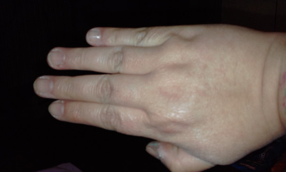 - (Finger, Krümmung)