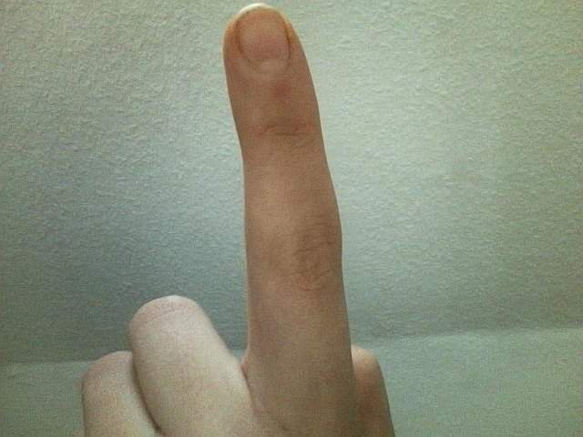 Wie Sieht Ein Gebrochener Finger Aus