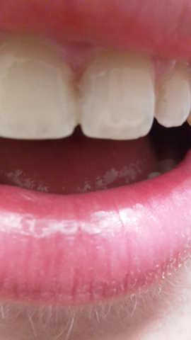 Kunststoff Zwischen Zahnlucke Verfarbt Zahne Zahnarzt Kieferorthopadie Kunststoff Zwischen Zahnlucke Verfarbt Zahne Zahnarzt Kieferorthopadie