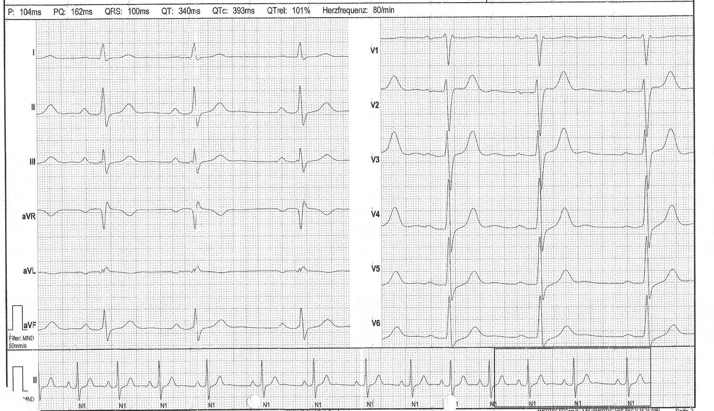 Liegt womöglich ein Herzfehler vor? Ist dieser EKG in Ordnung oder ist