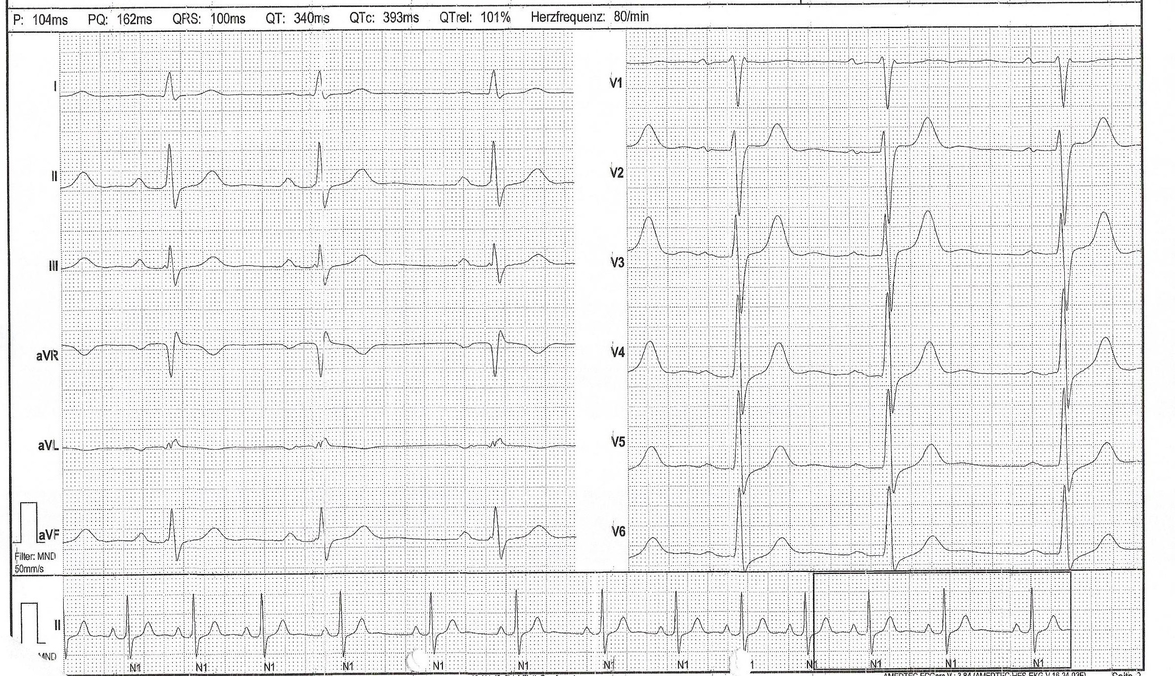 Liegt womöglich ein Herzfehler vor? Ist dieser EKG in