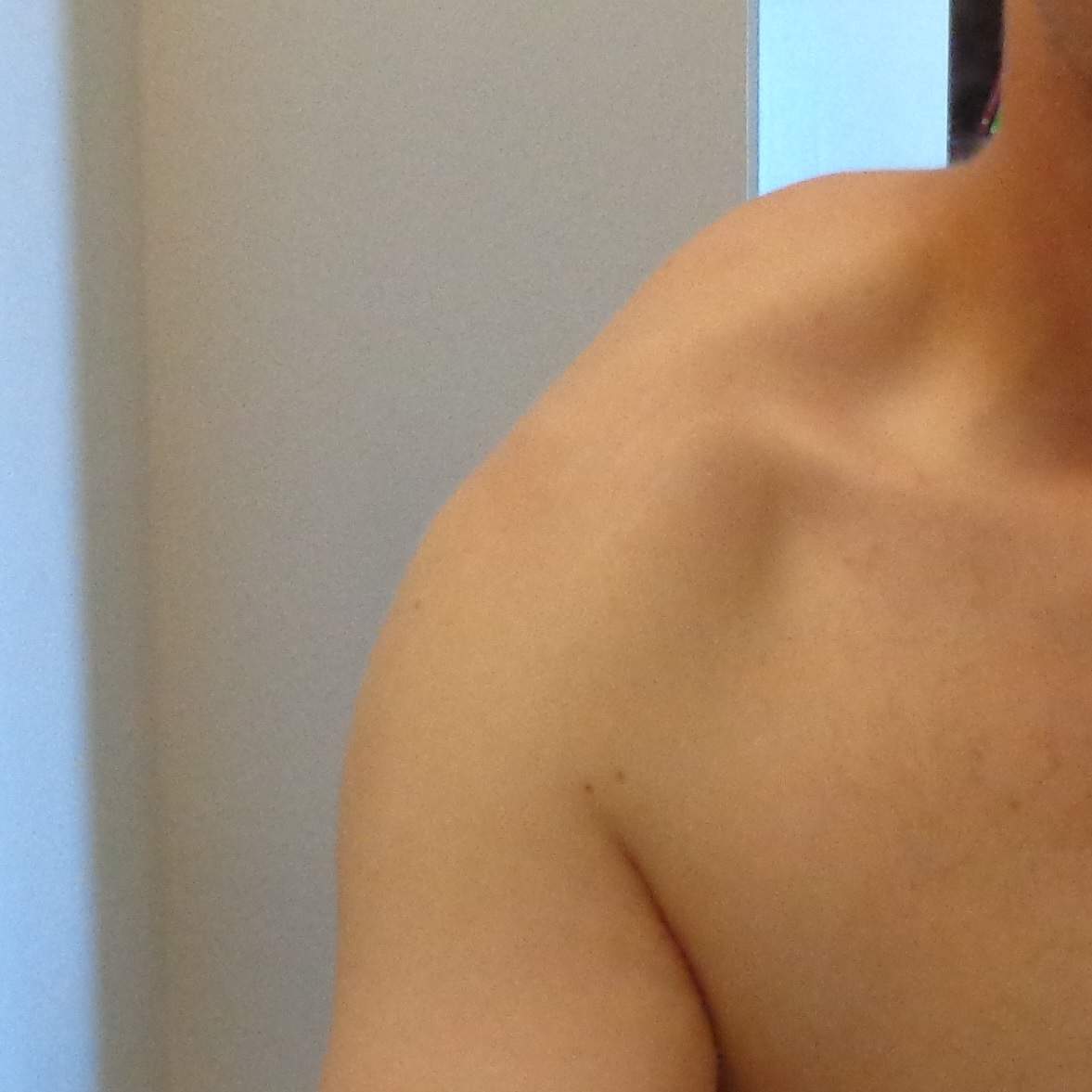 Linke Schulter Beule Beim Arm Heben Schmerzen Entzundung Linke Schulter Beule Beim Arm Heben Schmerzen Entzundung