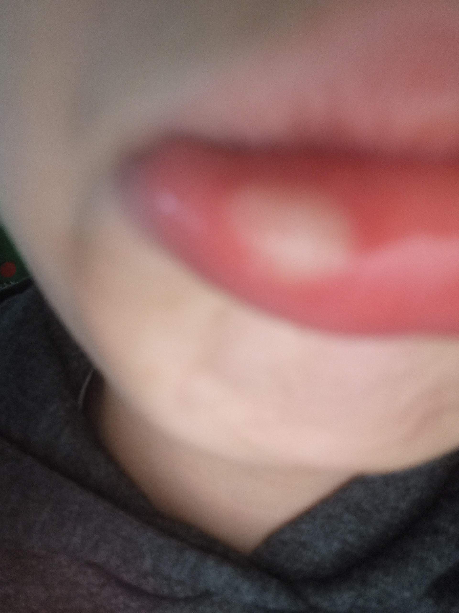 Lippe angeschwollen hilfe? (Lippenpflege)