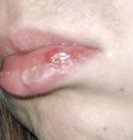 Lippe entzündet und geschwollen?