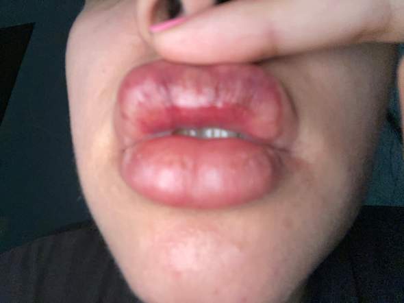 Lippen aufgespritzt ist das normal?