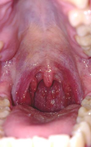 entzündeter rachen - (rachenentzündung  trockenheitsgefühl, weisser schleim lymphfolikel )