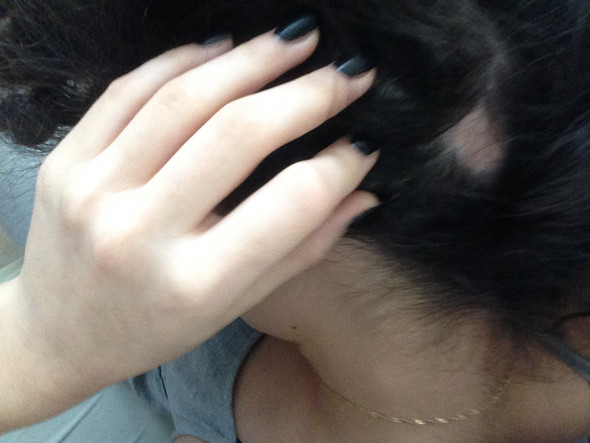 Loch In Der Kopfhaut