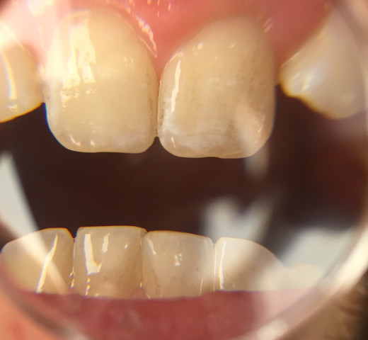 Bild der Flecken / Blasen - (Zähne, Zahnarzt)