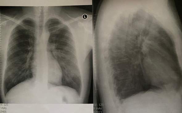 Lungen Krebs was sieht ihr im thorax Röntgen Bild? Hab auch bws schmerzen und reflux?