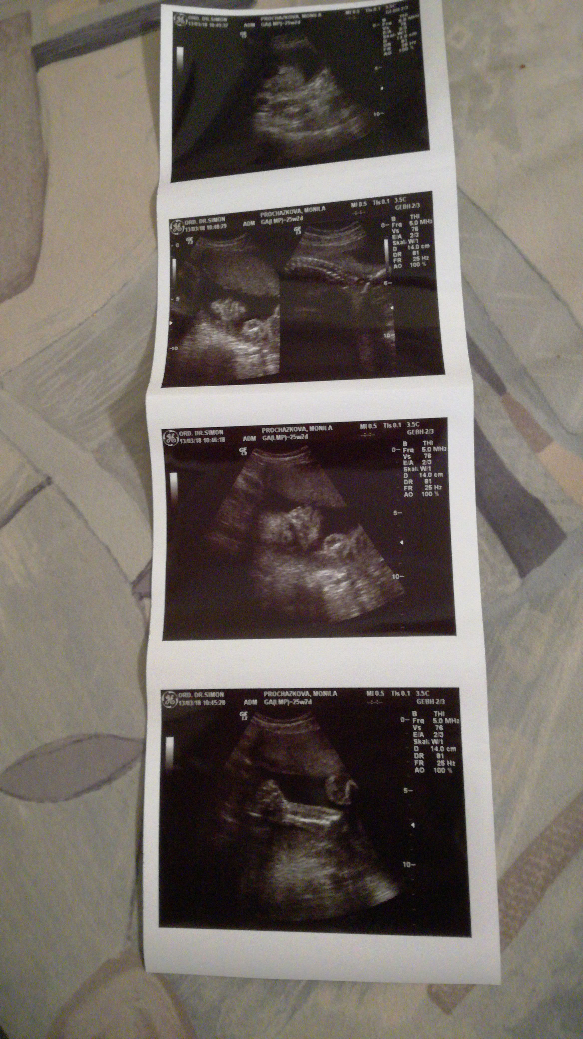 Madchen Oder Junge Schwangerschaft Ultraschall Geschlecht Madchen Oder Junge Schwangerschaft Ultraschall Geschlecht