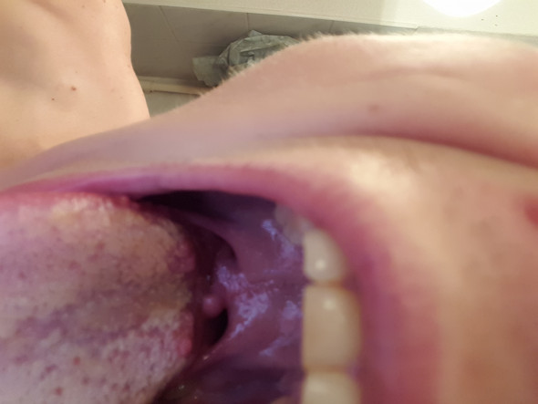 Die Zunge sieht jeden Tag so aus obwohl ich sie putze - (Magen, Pickel, Mund)