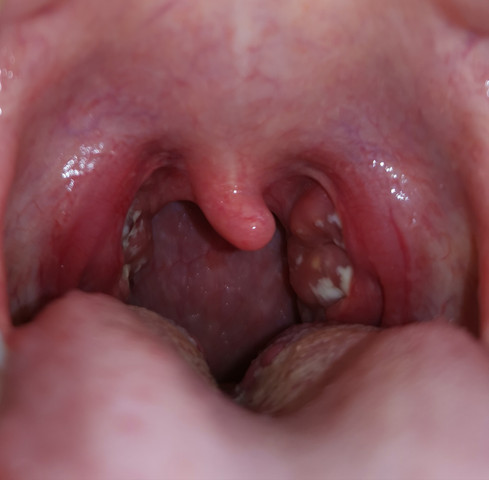 Stippchen mandeln Tonsillitis