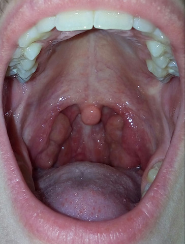 Hinter den Mandeln ist etwas Weißliches zusehen - (Hals, HNO, Mandelentzündung)