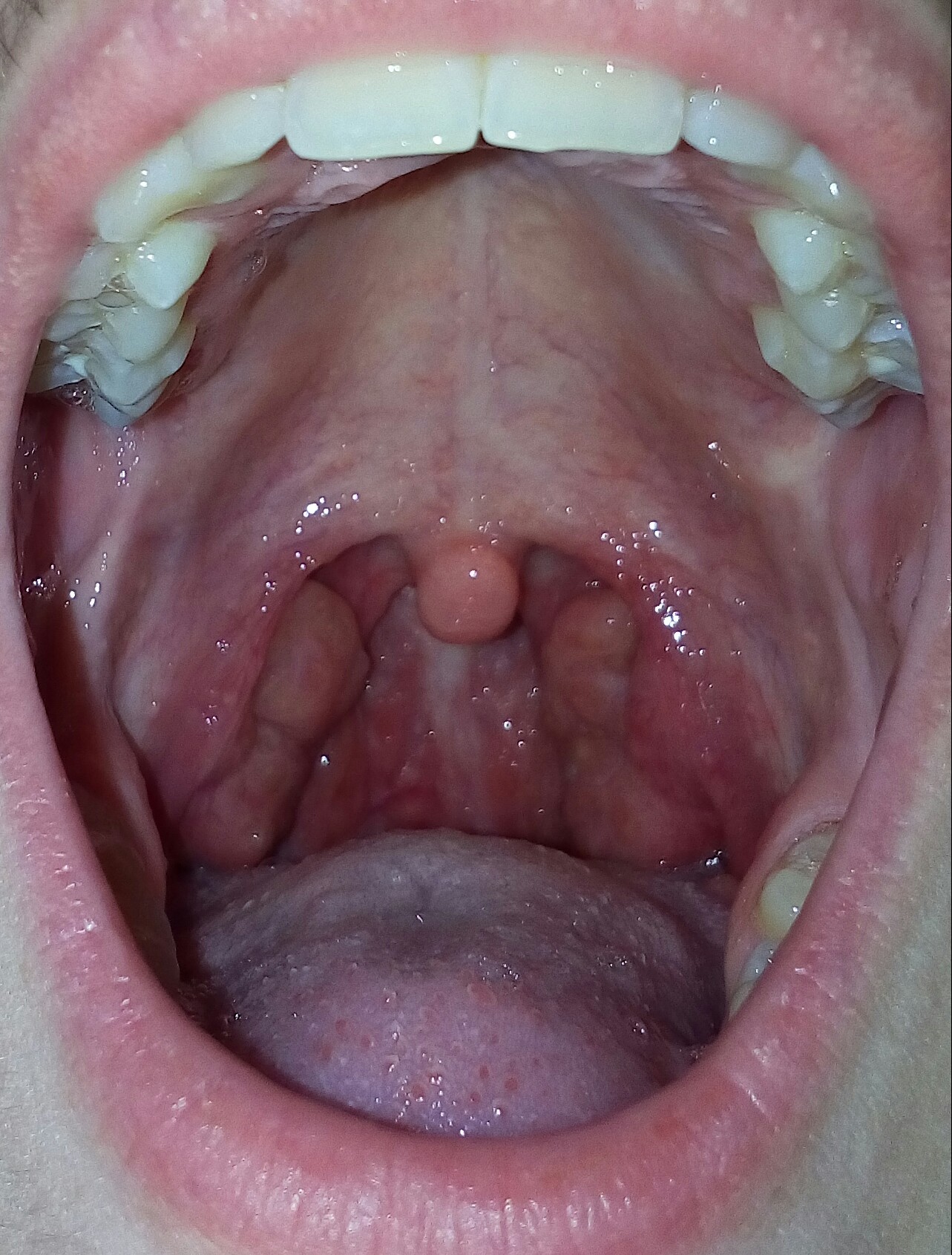 Mandelentzündung und Eiter im Rachenraum? (Hals, HNO, Rachen) Mandelentzündung und Eiter im Rachenraum? (Hals, HNO, Rachen)