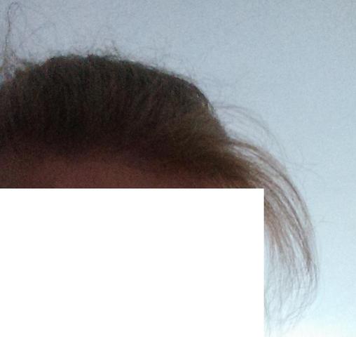 - (Juckreiz, Haare, Kopf)