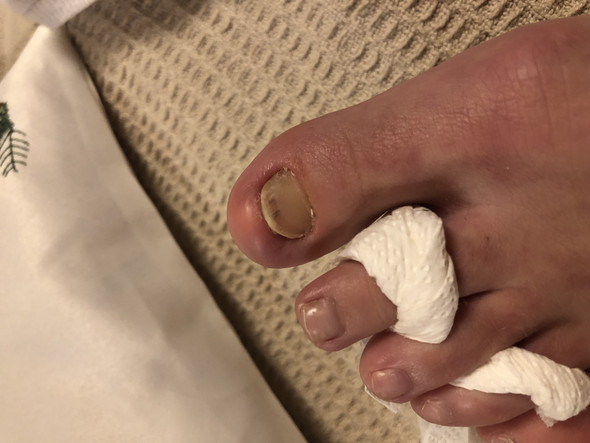 Mein Zehennagel Wachst Nicht Mehr Fusse Nagel Mein Zehennagel Wachst Nicht Mehr Fusse Nagel