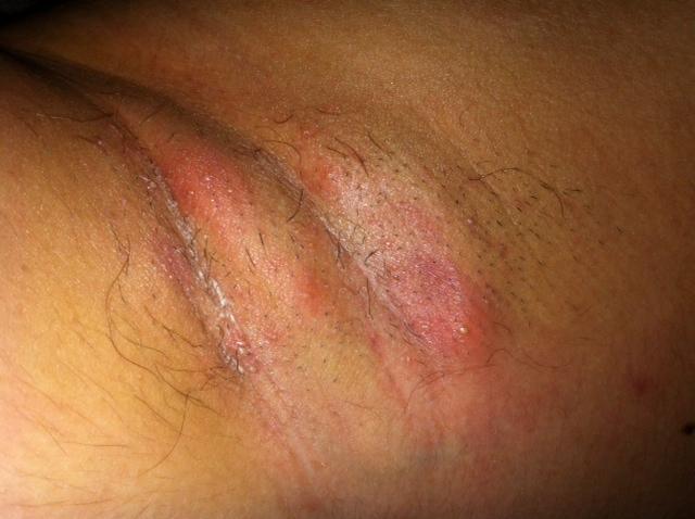 Get Pickel Mit Hartem Kern Video Pictures