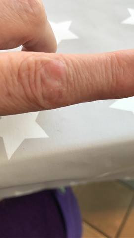 Meine Mutter Hat Auf Zwei Fingergelenken Folgende Knotchen Bild Anbei Was Ist Das Haut Entzundung Gelenke Meine Mutter Hat Auf Zwei Fingergelenken Folgende Knotchen Bild Anbei Was Ist Das Haut Entzundung Gelenke