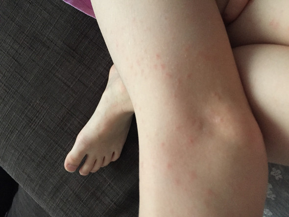 Meine Tochter hat plötzlich Hautausschlag?