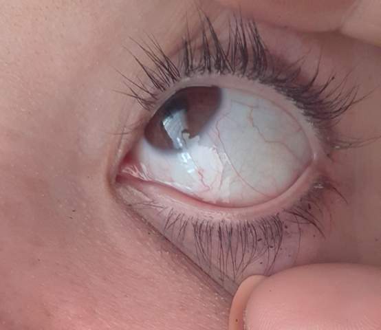 Meint Ihr Das Geht Weg Dicke Ader Im Auge Augen Meint Ihr Das Geht Weg Dicke Ader Im Auge Augen